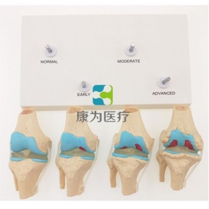 “康為醫(yī)療”四階段病變膝關(guān)節(jié)模型，4階段膝關(guān)節(jié)模型