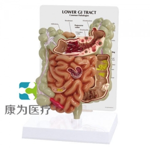 “康為醫(yī)療”醫(yī)患關(guān)系溝通模型-病理大、小腸模型（醫(yī)學(xué)指導(dǎo)模型）