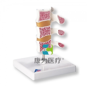 豪華型骨質(zhì)疏松癥模型，3塊椎骨