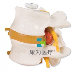 帶椎間盤脫出的2塊腰椎，活動安裝