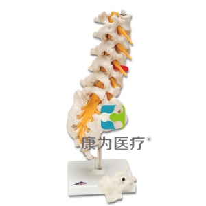腰脊柱，有脊外側(cè)椎間盤脫出