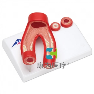 動(dòng)脈硬化模型，帶動(dòng)脈切面，2部分